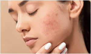 Khi trị mụn bằng bột đậu đỏ cần lưu ý các hiện tượng da bị kích ứng và ngưng sử dụng để xử lý kịp thời